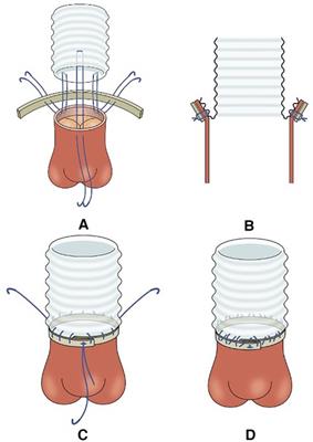 Modified turn-up technique for proximal anastomosis in acute aortic dissection type A has potential to facilitate stable outcomes for low-volume early-career surgeons